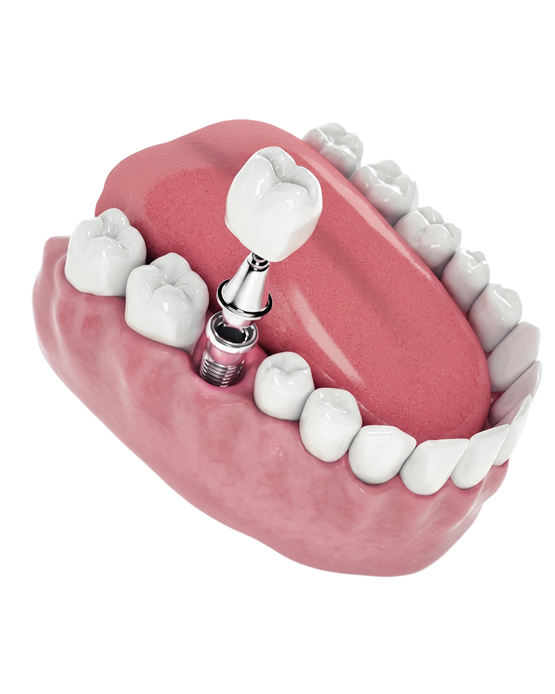 Paciente com sorriso reabilitado — Oral Estetic
