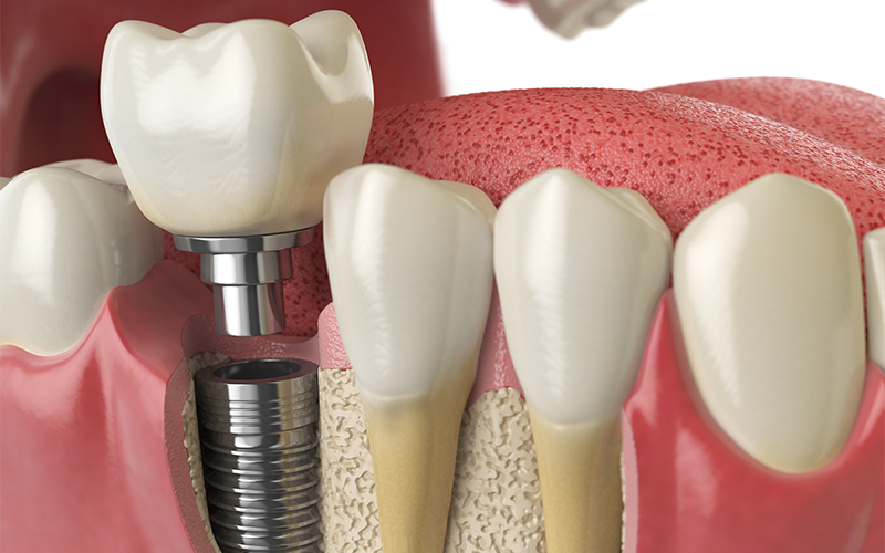 Procedimento de implante dentário — Oral Estetic