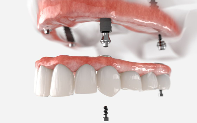 Prótese dentária sob medida — Oral Estetic